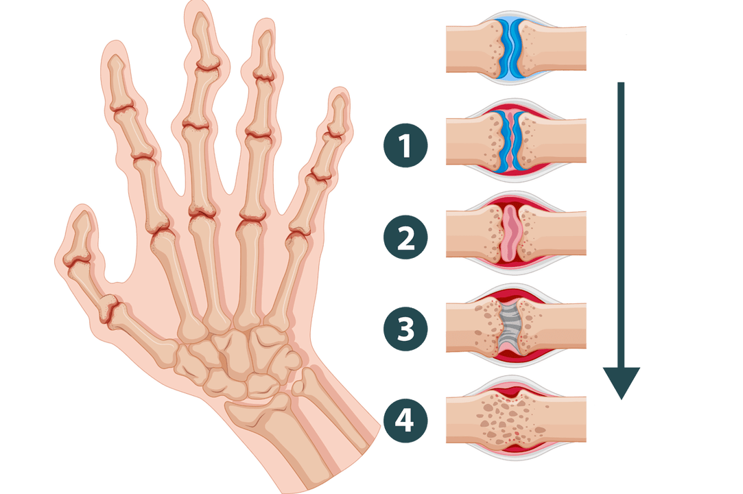 Stages of development of arthritis - joint damage due to inflammation
