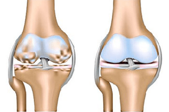 Healthy joints and joints