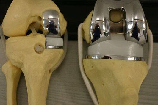 The variants of endoprosthetic of the knee joint