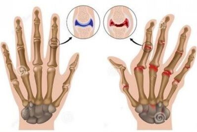 Causes of pain in the joints of the finger