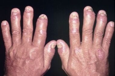 Why the joints of the finger are damaged