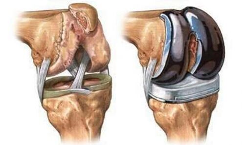 The inner knee joint for arthritis