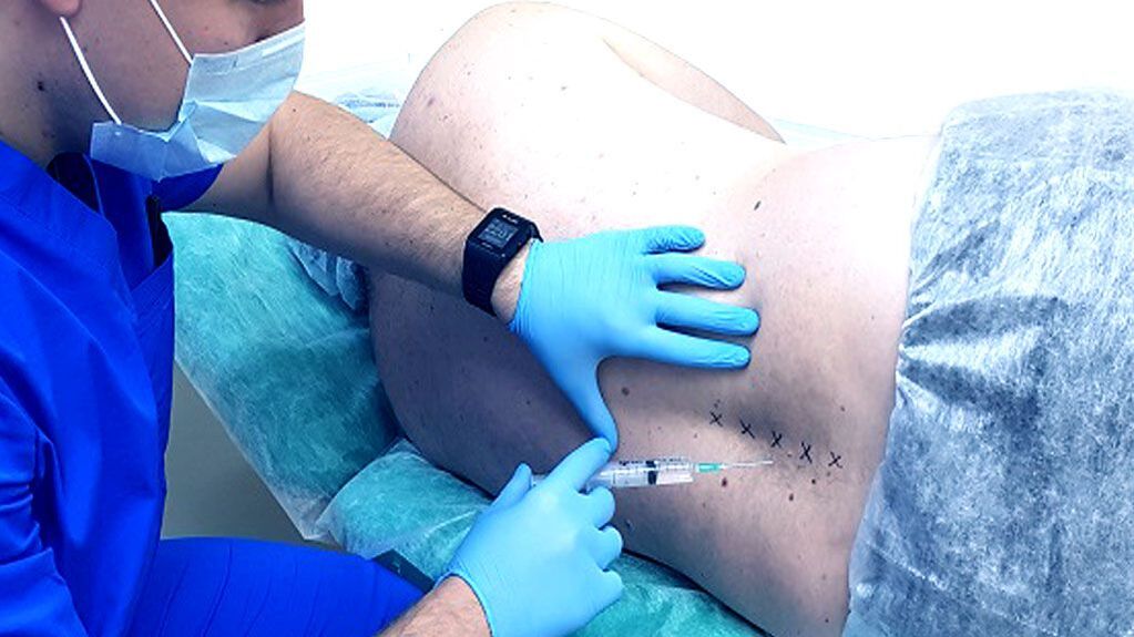Spinal block for osteoarthritis
