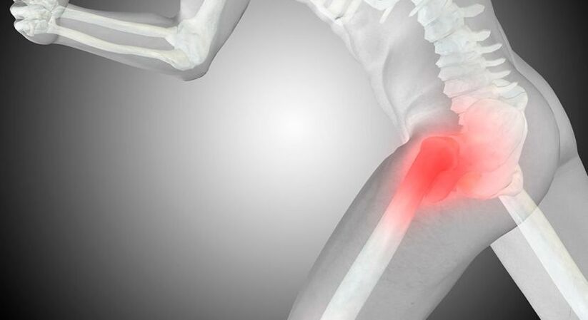 hip arthritis