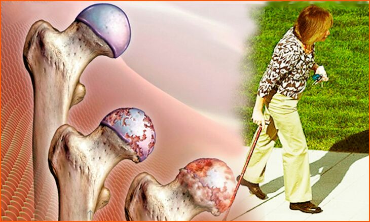 Persistent limping in the late stages of hip osteoarthritis