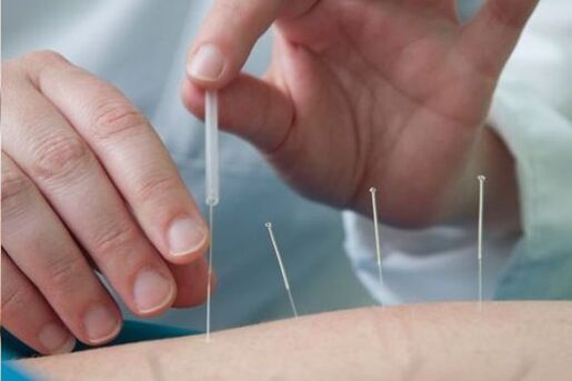 Acupuncture is a method of treating low back pain caused by osteoarthritis