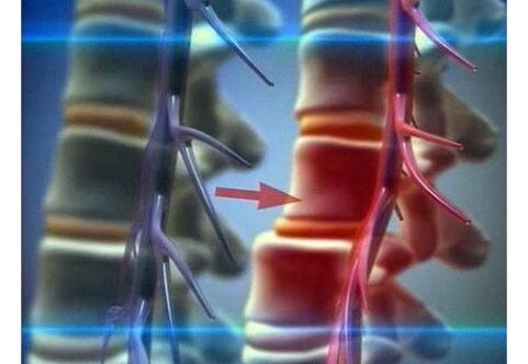 Compression of nerve endings in lumbar osteoarthritis
