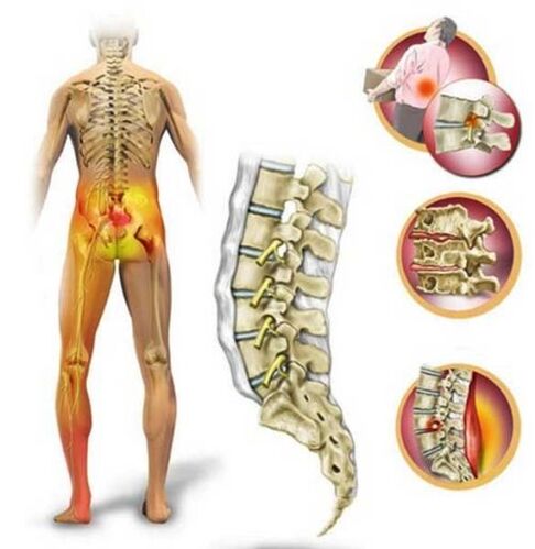Degeneration of the lumbar spine, causing lower back pain