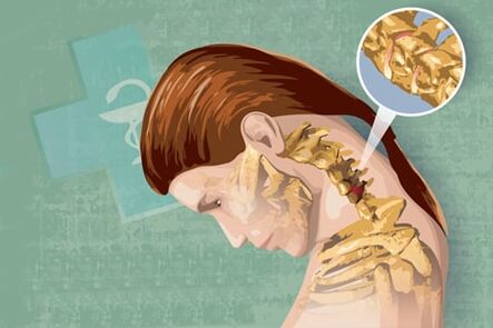 Reflex symptoms of osteoarthritis