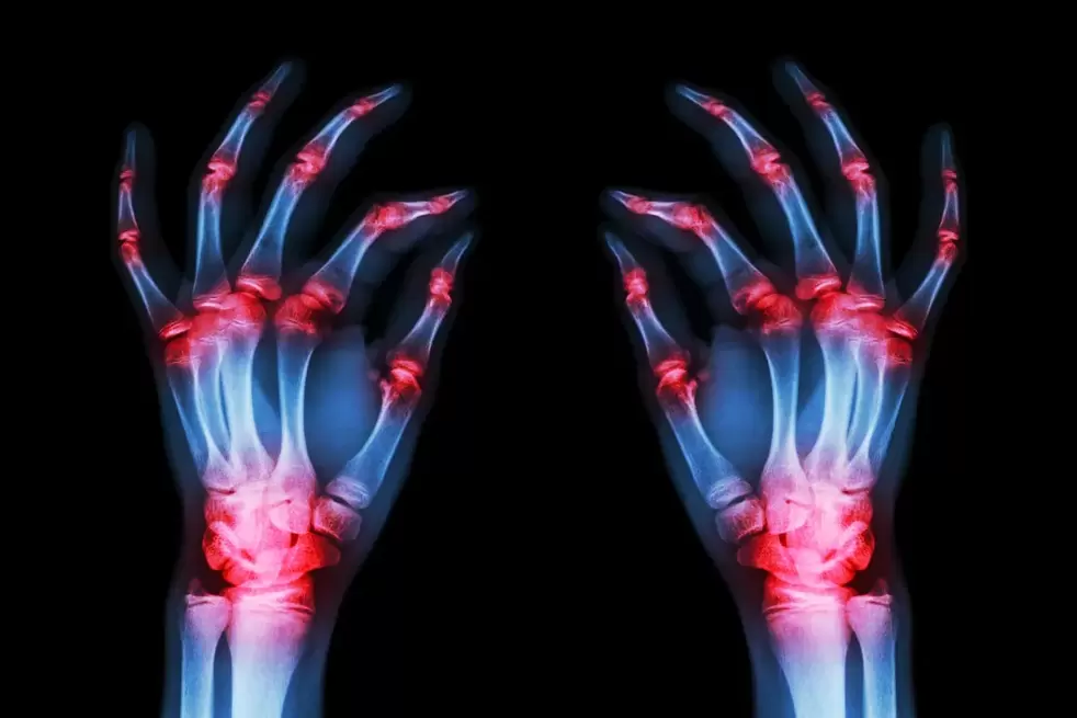 Arthritis of finger joints