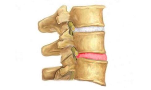 Protrusion of the discs of the spine - a sign of osteonecrosis
