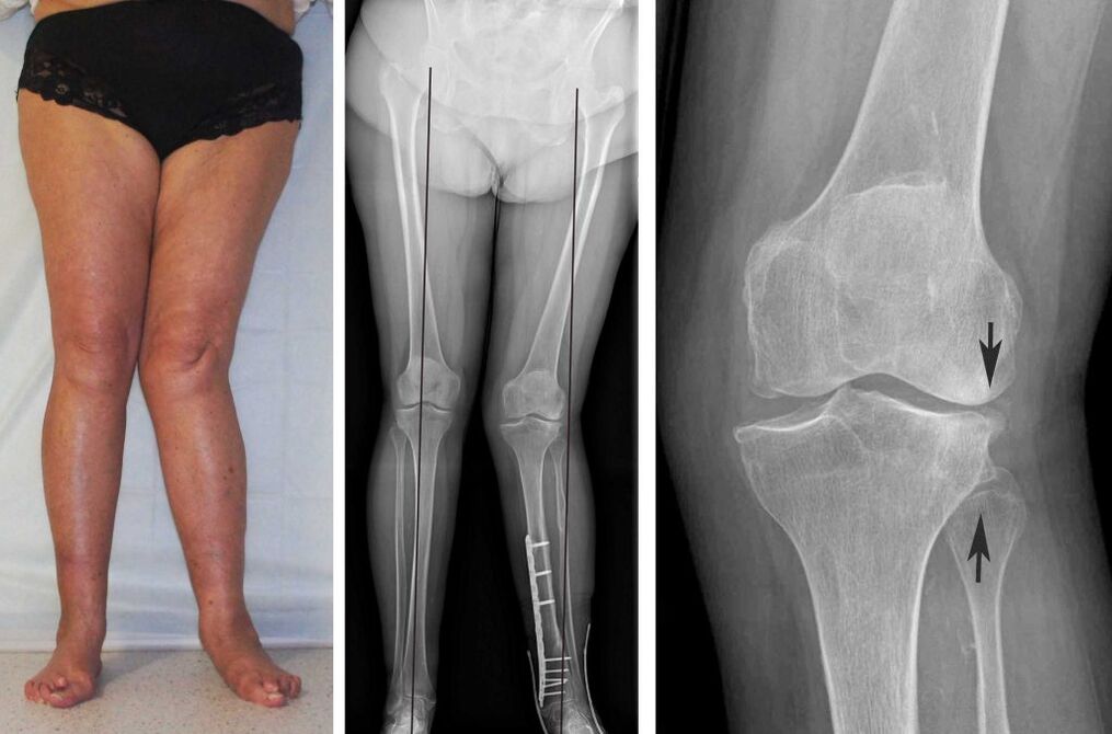 Clinical picture of knee osteoarthritis