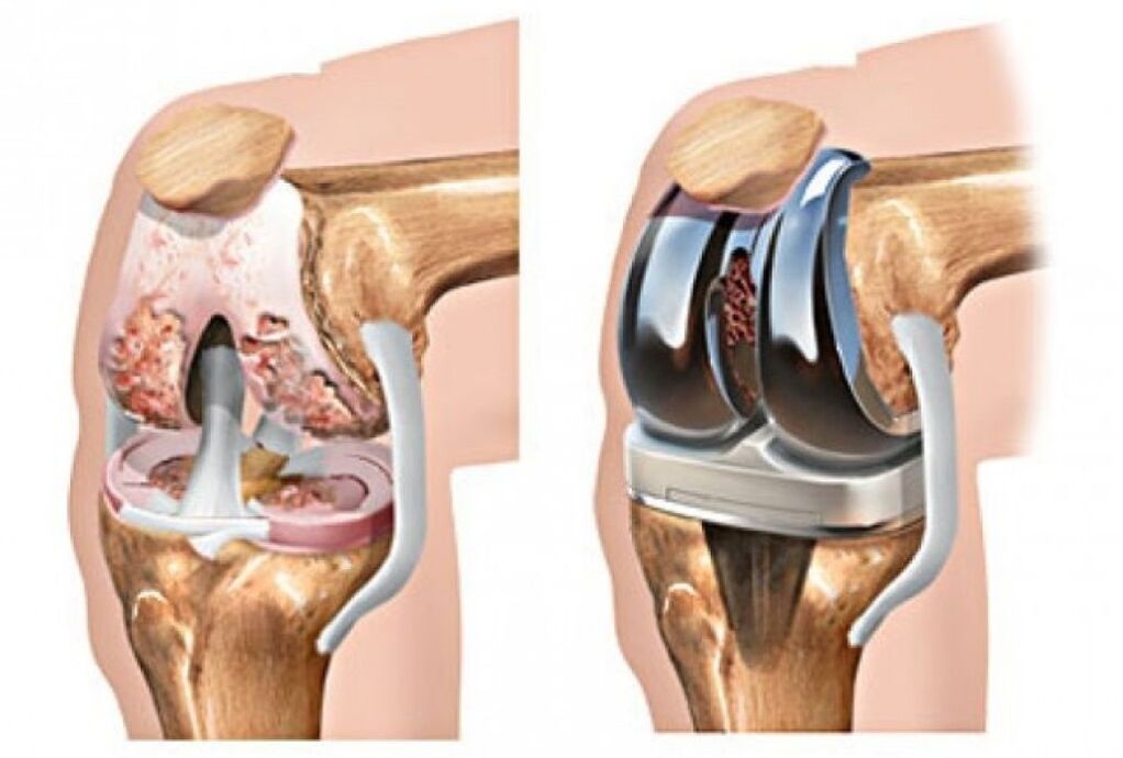 Knee arthroplasty for joint disease