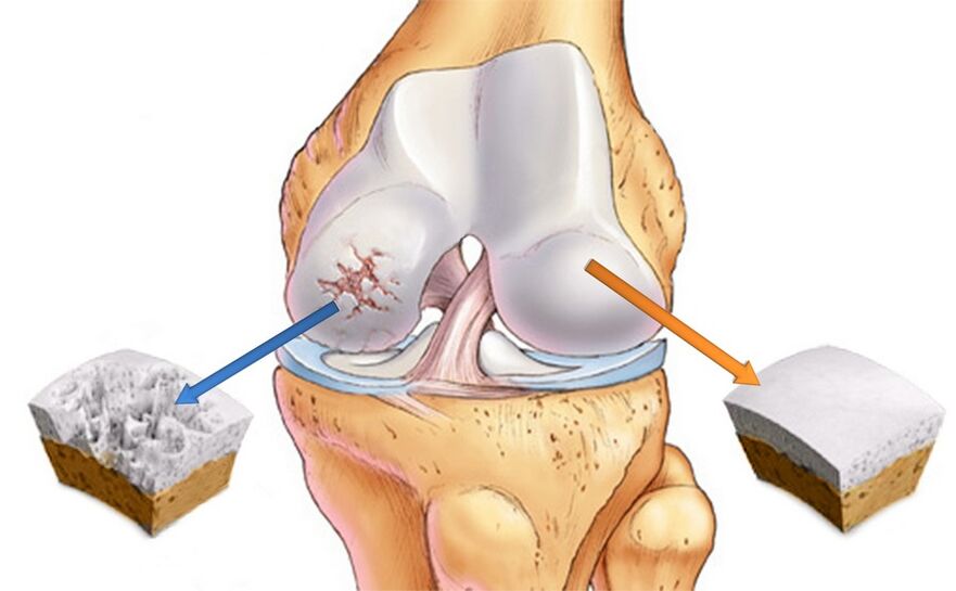 Healthy knee joint (right) and osteoarthritis (left)