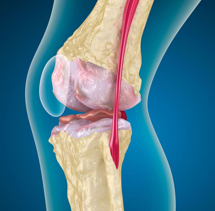 Osteoarthritis of the knee - a degenerative-dystrophic disease