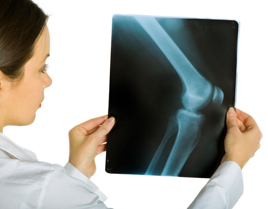 X-ray of the knee joint will reveal the presence of joint deformity