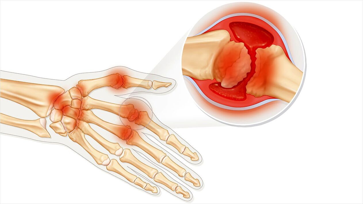 joint disease treated with Traugel